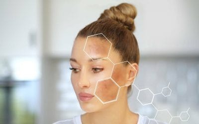 5 Great Ways to Treat and Prevent Hyperpigmentation