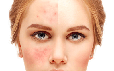 Great Rosacea Treatments to Help You Achieve Clearer Skin