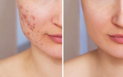 Innovative Acne Treatments: LED Therapy and Peels