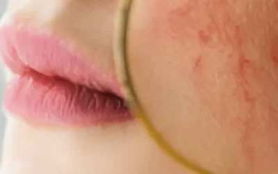 Effective Rosacea Treatments: Calm Your Skin, Boost Your Confidence