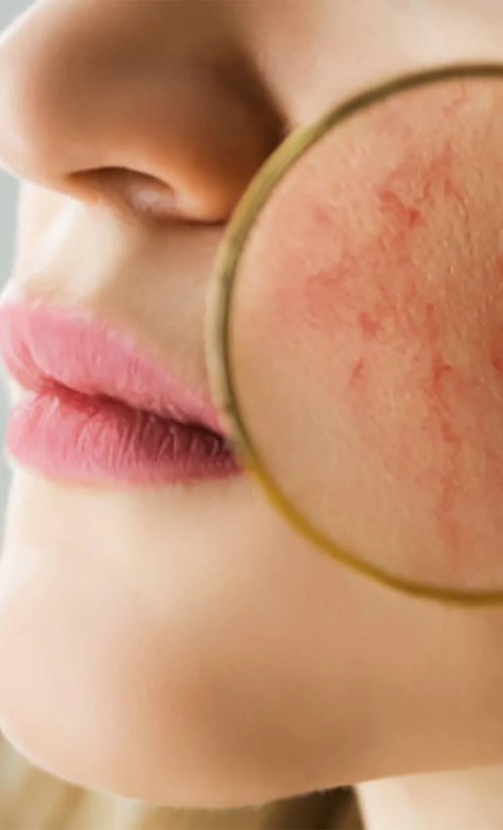A magnifying glass shows red, irritated skin on a woman's cheek near her lips.